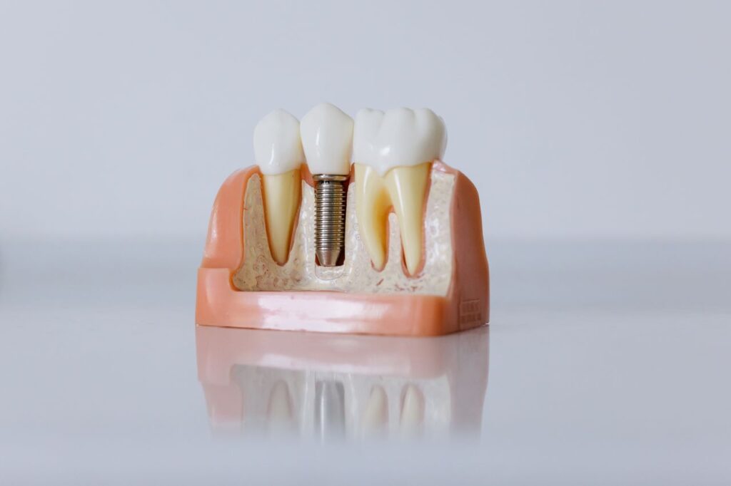 Close up dental implant
