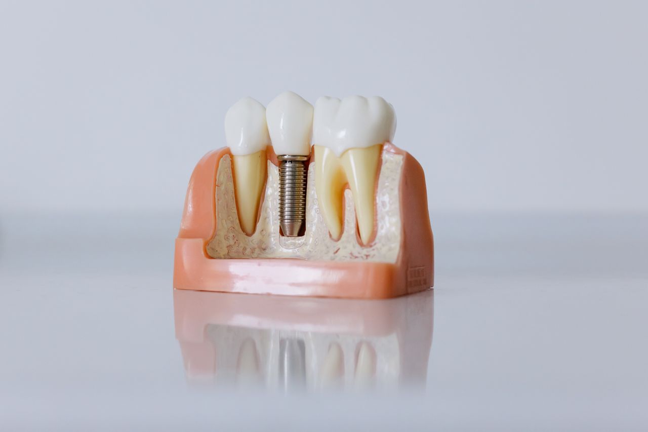 Close up dental implant